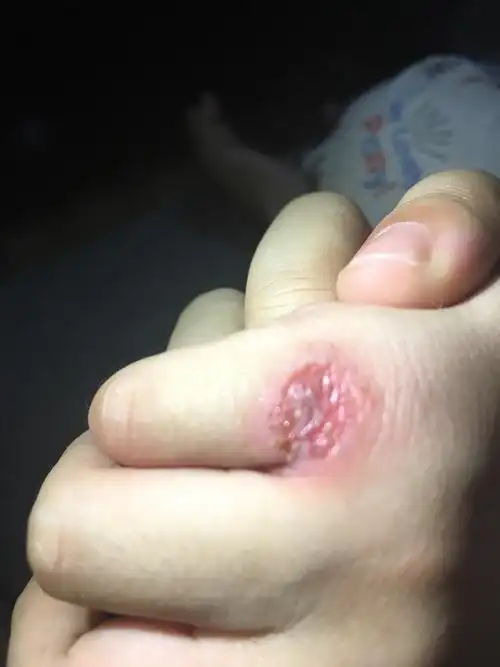 孩子手溃烂,什么原因哦