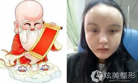 担心脂肪填充变寿星?上海伊莱美多层次多维度案例更自然