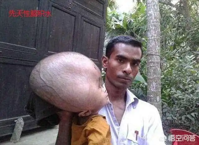 头条问答 - 有些小孩脑袋特别大是怎么原因?(8个回答)