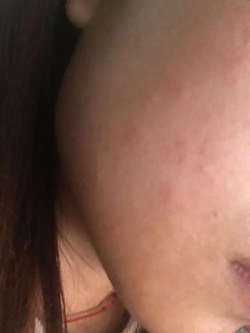 脸上最近长了很小很小时痘痘,去化妆品店说是脂肪粒,怎么办?