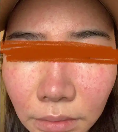 脸部皮肤又红又痒,是过敏了吗?正确的护理方法要牢记