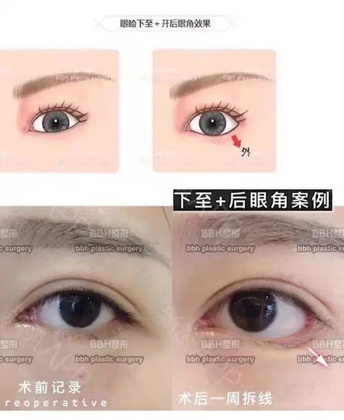 客人做外眼角77眼睑下至的术后对比