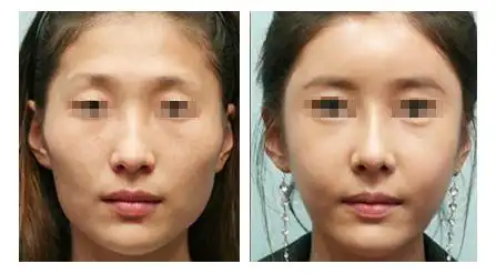 整个人一点精神都没有,自体脂肪面部填充术可以帮女士把脸面提升起来