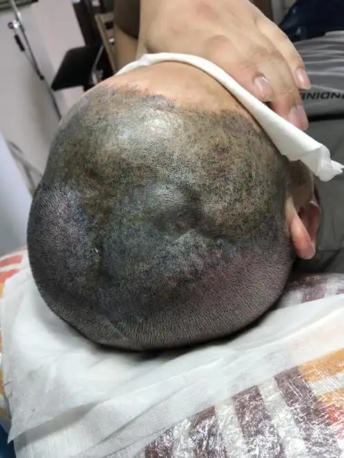 客人四岁时因意外头部烫伤,后期经植皮注水拉伸治疗,头皮有的部位已经
