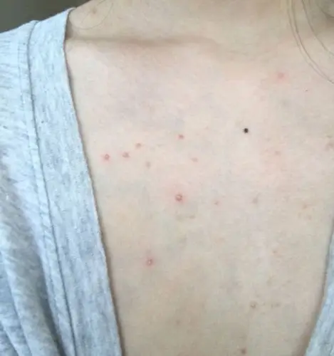 最近胸前长了好多粉刺样的痘痘,怎么回事啊啊啊?怎么办?