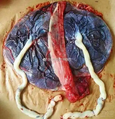 一个漂亮的双胞胎胎盘(符合这几个标准才算) - 丁香园论坛