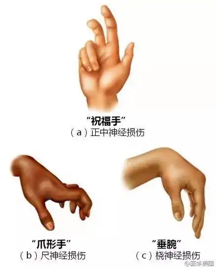 正中神经损伤——拇,食,中指不能屈曲,拇指不能外展和对掌,手掌桡侧3