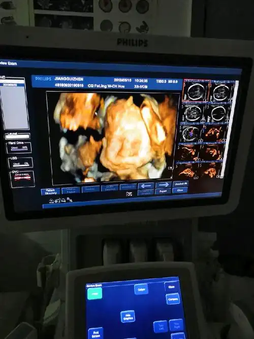 四维彩超通过,感觉好丑,第一次没照到脸,走了半小时才照了这么一张