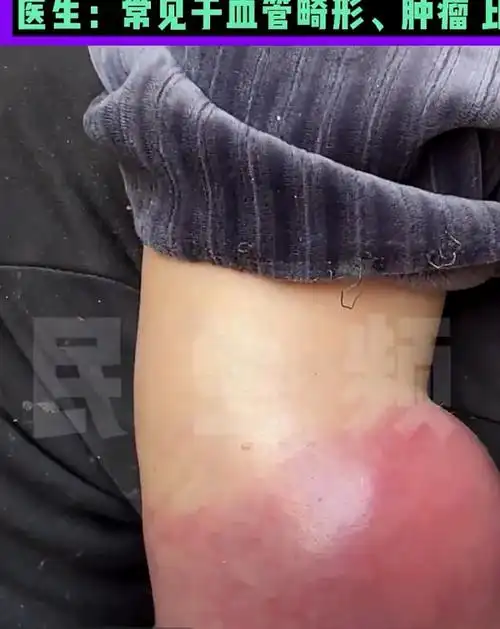 1岁男童患罕见病,小腿肿成"象腿"无法行走,一天能长一公分