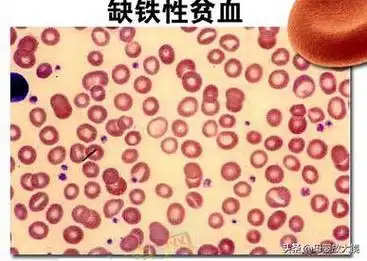 5个孩子就有1个缺铁性贫血,家长注意了,这些事情不能忽略|红细胞|含铁