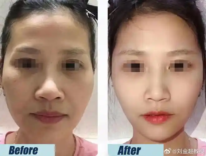 整形##自体脂肪填充##自体脂肪面部填充