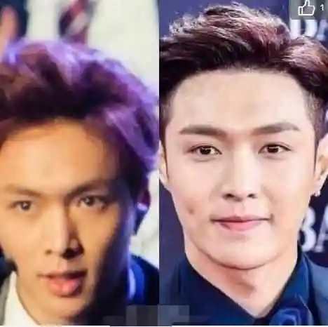 网友扒出了张艺兴发际线移植后跟之前照片的对比