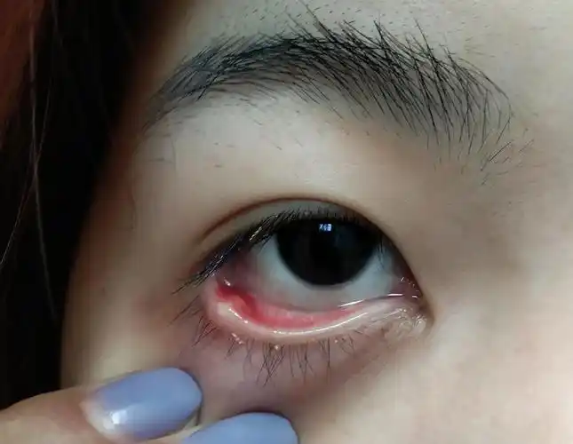 急!大家可以帮我看看这个是麦粒肿吗 要做手术切吗