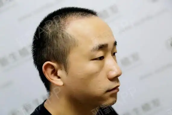 头发已经长出了大概两厘米,与周围的头发毫无异样,最_圈子-新氧美容