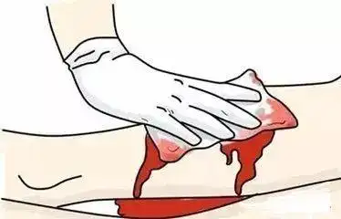 居家旅行必备:正确的伤口处理法你会吗?