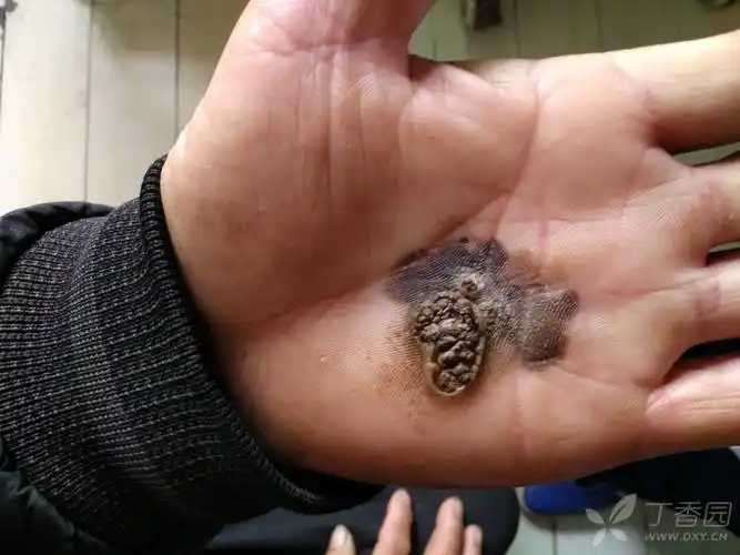 左手掌黑色肿块考虑什么病? [病例帖]