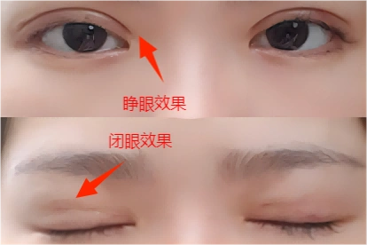 埋线双眼皮1个月恢复效果