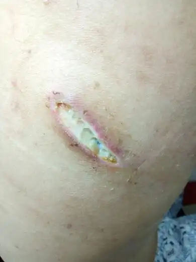 手术后伤口发炎,怎么处理?