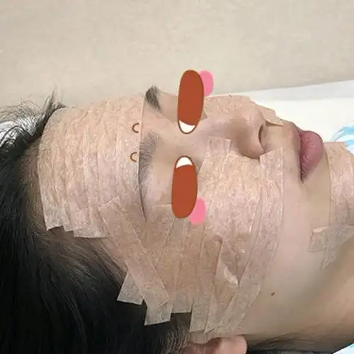 自体脂肪填充面部第3天!