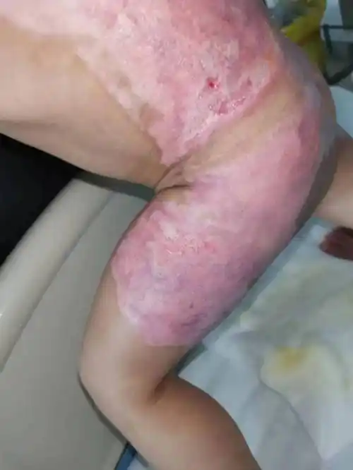 心疼!钦州一名2岁宝宝被热水严重烫伤,家长们一定要警惕