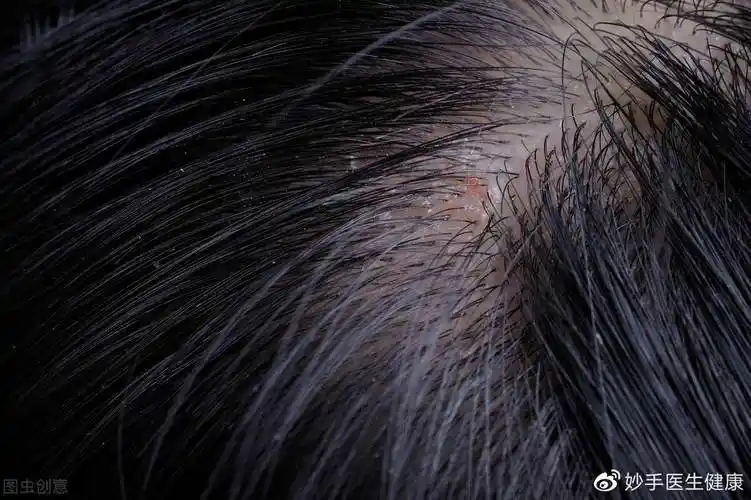 当心是脂溢性皮炎!想快速摆脱,建议首选这个方案
