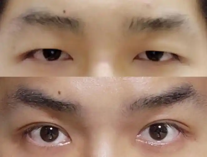 男生割双眼皮怎么看?