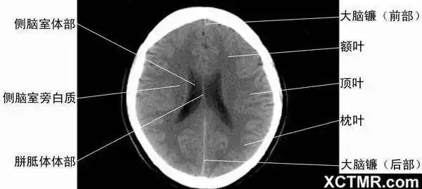 学习这些颅脑ct图,大脑运动起来升升温吧!
