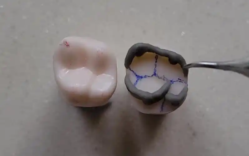 上颌第一磨牙的初级形态堆塑(基本但重要)