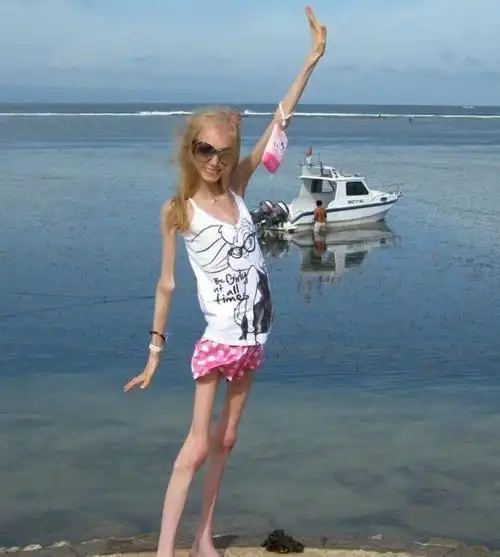 瘦成干尸的少女kseniya bubenko 世界上最瘦的人体重仅20公斤(患厌食