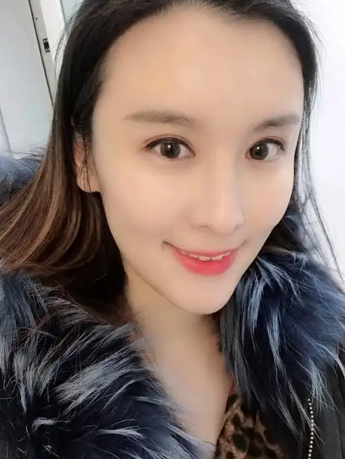 做脸部的自体脂肪填充快一个月了,恢复的还是比较快的_圈子-新氧美容