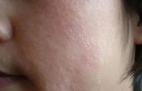 秋冬换季,皮肤瘙痒起皮潮红,你该这么护理!