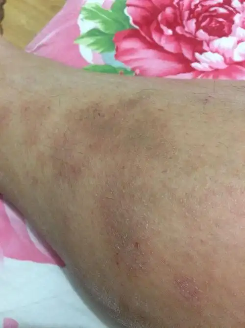 腿上起了这个,越挠越痒,挠完后皮肤发硬起包,可能还传染,是什么病