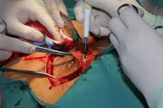 切除手术中切除后并切开转移皮瓣后的创面皮瓣转移修复切除标本,囊肿