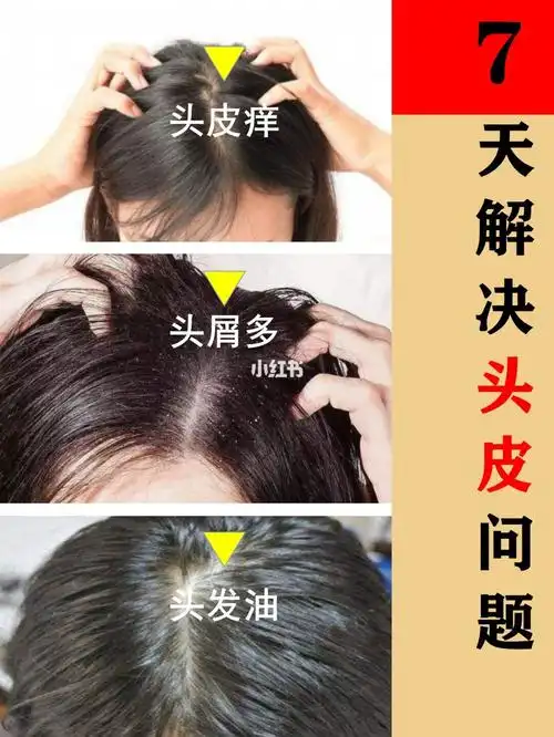 脂溢性皮炎_皮炎_头皮屑_脱发_去屑洗发水_洗发_维生素b_血液循环