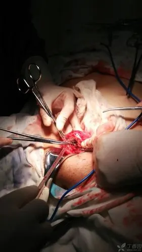 避孕环肌层嵌顿取出时部分残留 [病例帖]