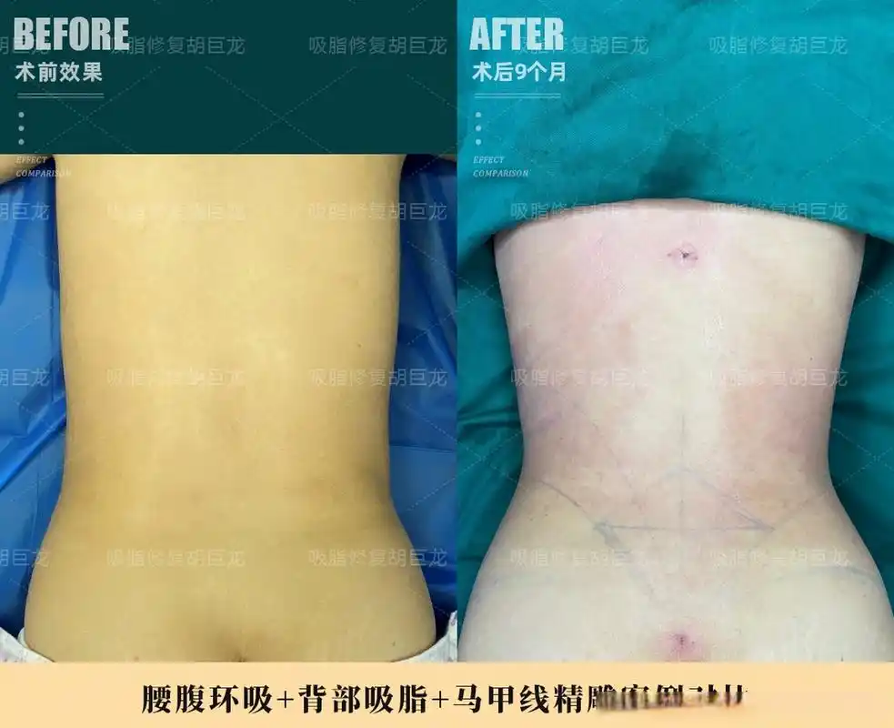 这个是我昨天做的#腰腹环吸#  #背部吸脂#  #马甲线精雕# 案例对比
