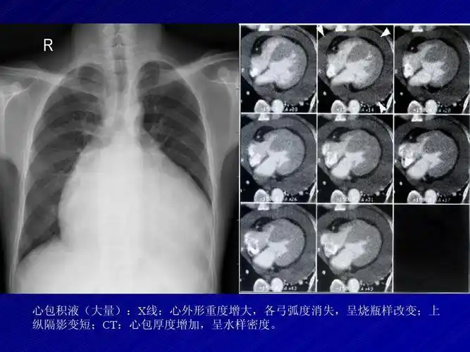 心包积液(大量):x线:心外形重度增大,各弓弧度消失,呈烧瓶样改变;上