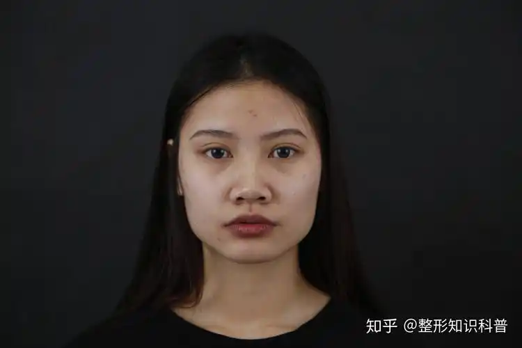 上海丽质美学整形【塌鼻做鼻综合前后对比】-塌鼻子手术矫正 - 知乎