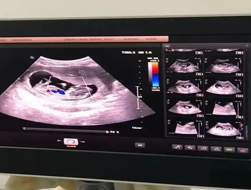 nt小于1.5就一定是女孩吗(过来人说法vs妇科专家说法)