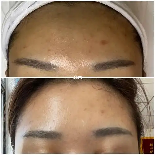 一次祛痘加补水的前后对比