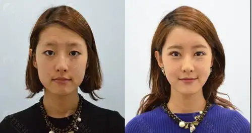 脸型扁平颧骨宽做脂肪填充有用吗脂肪怎样填充效果好