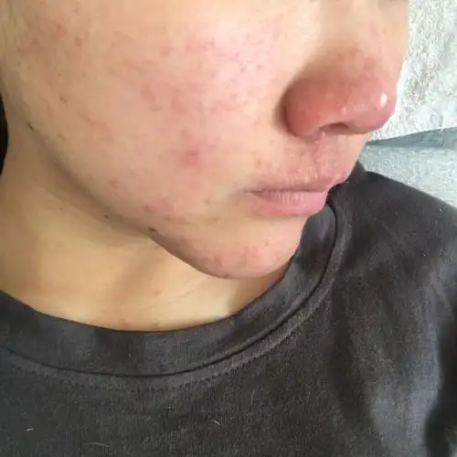 l一直是敏感皮肤,前一阵鼻子下面人中上突然长了很多痘,用过芦荟胶,没