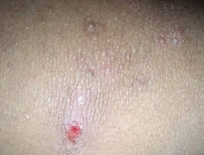 这是什么疙瘩啊,应该怎么办