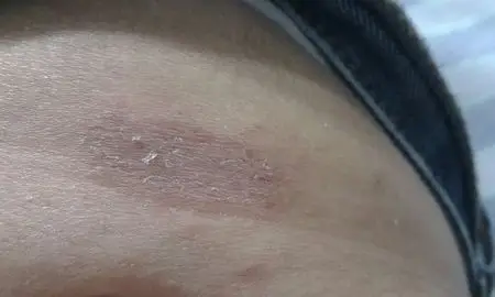 牛皮藓还是皮藓,不痛不痒.