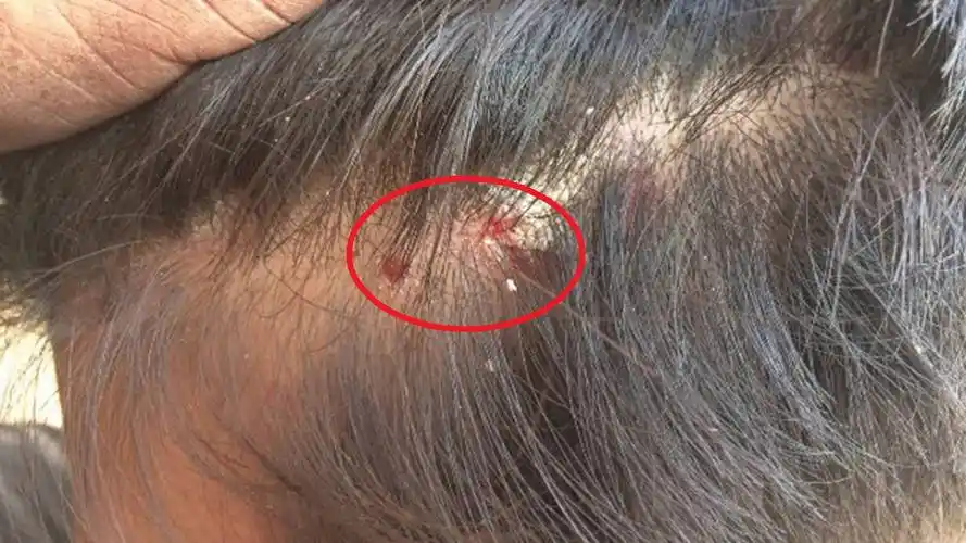 长春肤康医院浅谈毛囊炎分为哪些类型其症状分别是什么