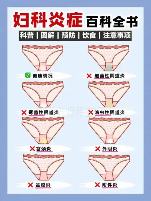 孕健康!妇科炎症怎么预防"价格合理"-第2张图片-哈市博客
