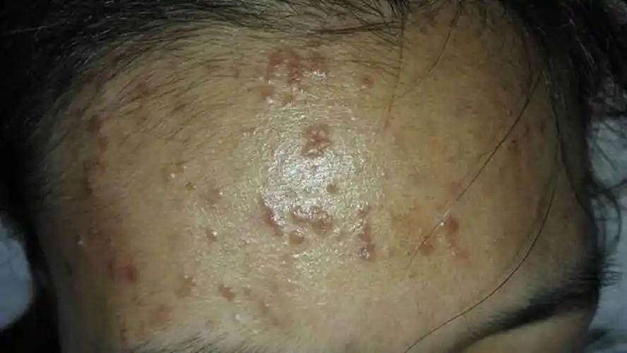 额头上丝状疣症状的图片