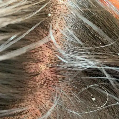 有图慎入这种头部脂溢性皮炎还有救吗