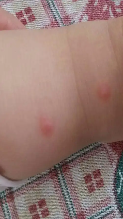 问:八个半月小孩起小红疙瘩四五天,现在四肢和脸部都有疙瘩