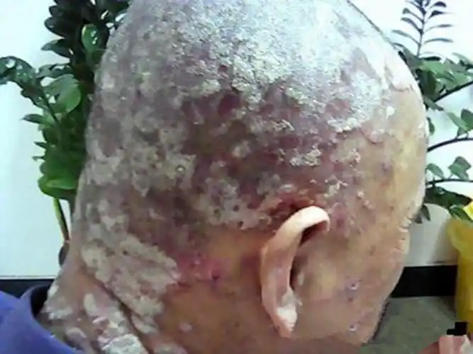 女生的头癣初期图片_有来医生